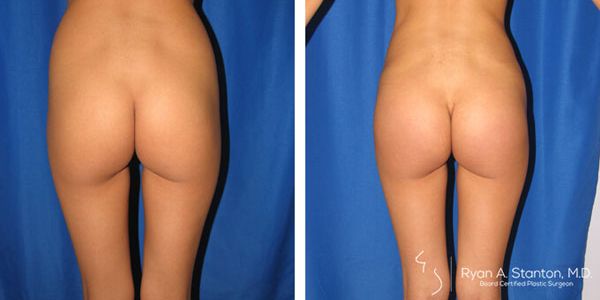 before and after buttock implant back view female patient case 1059