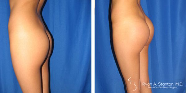 before and after buttock implant left side view female patient case 1059