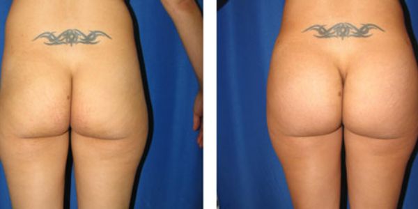 before and after buttock augmentation back view female patient case 1062