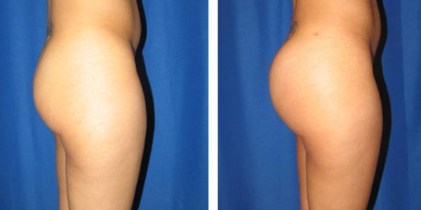 before and after buttock augmentation left side view female patient case 1062