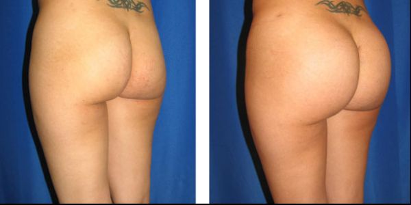 before and after buttock augmentation right angle view female patient case 1062