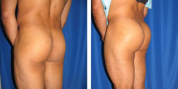 before and after male butt augmentation right angle view male patient case 1066