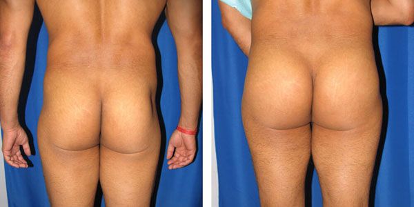 before and after male buttock augmentation back view male patient case 1066