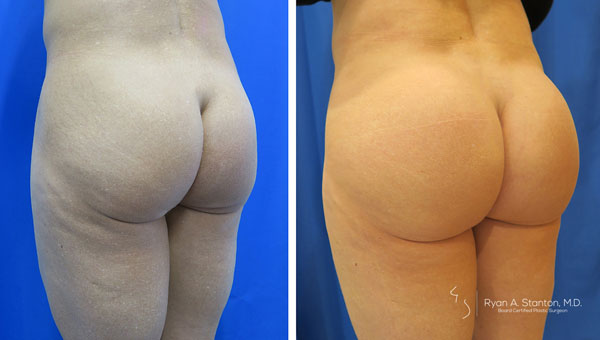 before and after butt implant left angle view of female patient 586