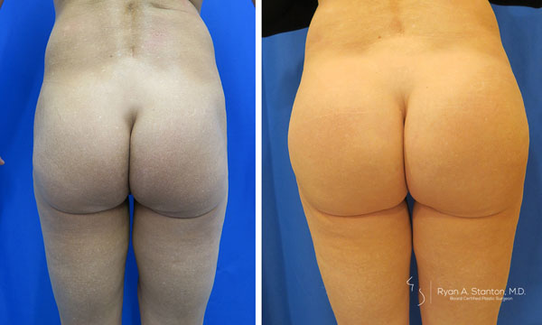 before and after butt implant front view of female patient 588