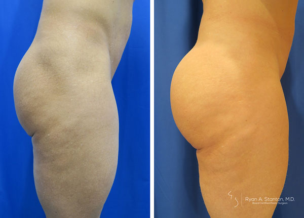 before and after butt implant right side view of female patient 590