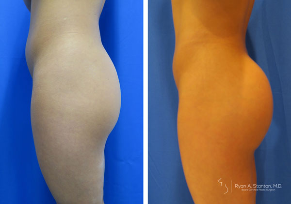 before and after butt implant left side view of female patient 592