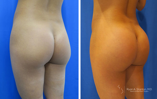 before and after butt implant left angle view of female patient 594