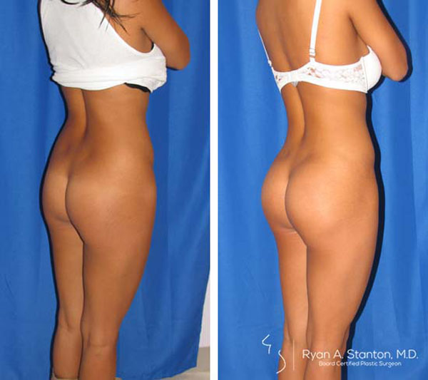 before and after butt implant right angle view of female patient 596