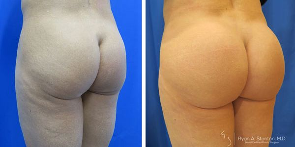 before and after buttock implant left angle view of patient 687