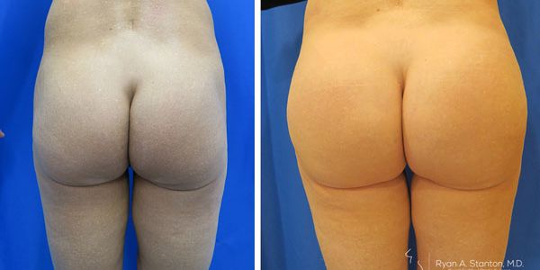before and after buttock implant rear view of patient 687