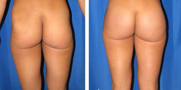 before and after buttock implant rear view of patient 692