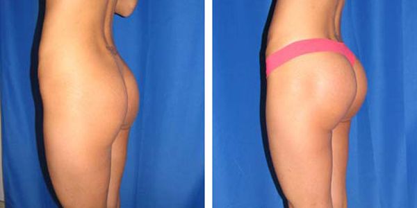 before and after buttock implant left side view of patient 694