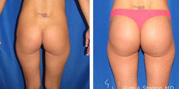 before and after buttock implant rear view of patient 694