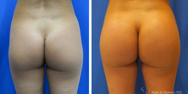before and after buttock implant rear view of patient 697