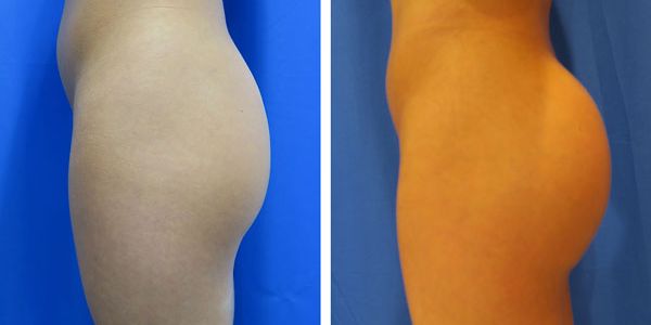 before and after buttock implant left side view of patient 697