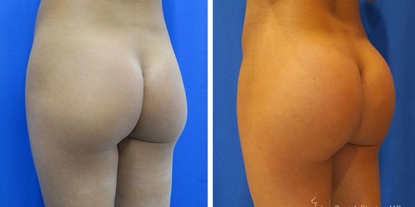 before and after buttock implant left angle view of patient 697
