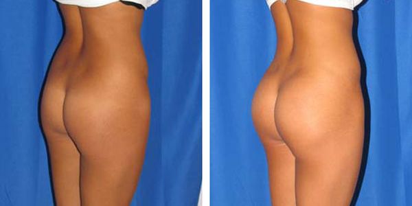 before and after buttock implant right angle view of patient 707