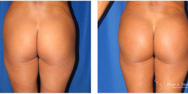 before and after buttock implant rear view of patient 711