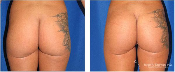 before and after buttock implant rear view of patient 715