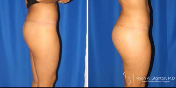 before and after buttock implant right side view of patient 718