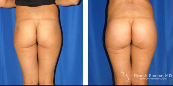 before and after buttock implant rear view of patient 718