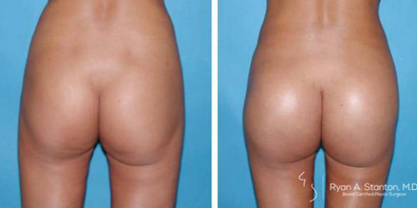 before and after buttock implant rear view of patient 721