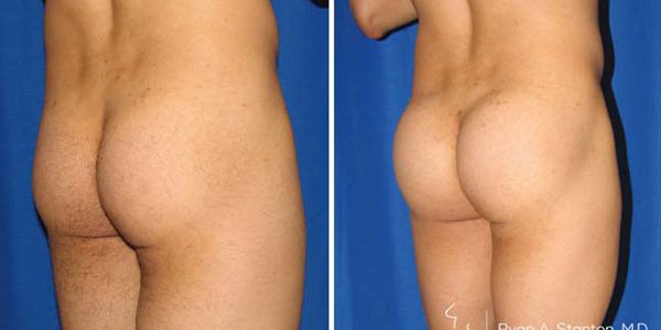 before and after buttock implant right angle view of male patient 723