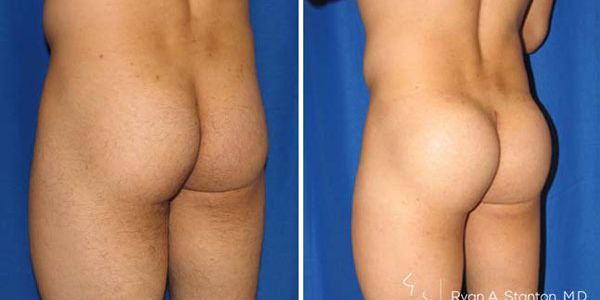 before and after buttock implant left angle view of male patient 723