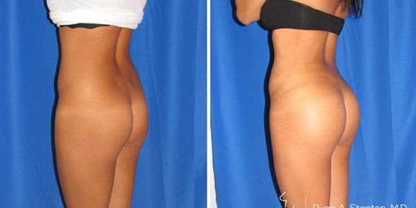 before and after buttock implant left angle view of female patient 726