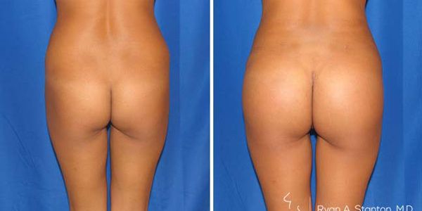 before and after buttock implant rear view of female patient 726