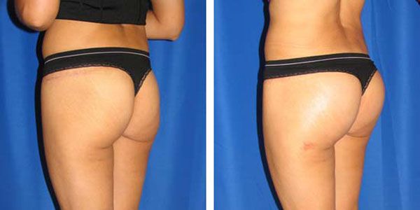 before and after buttock implant left angle view of female patient 729