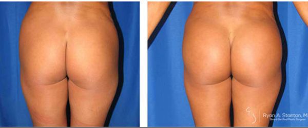 before and after buttock implant rear view of female patient 731