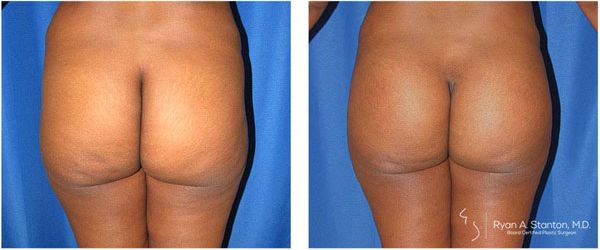 before and after buttock implant rear view of female patient 733