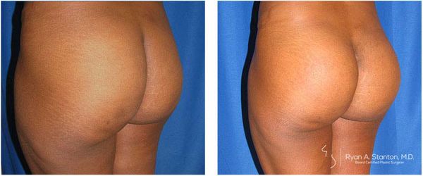 before and after buttock implant left angle view of female patient 733