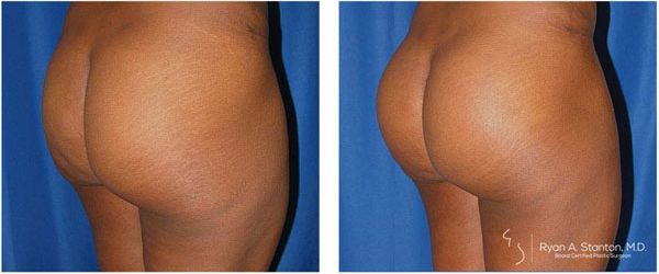before and after buttock implant right angle view of female patient 733