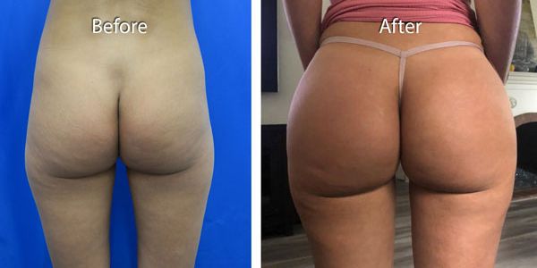 before and after buttock implant rear view of female patient 740