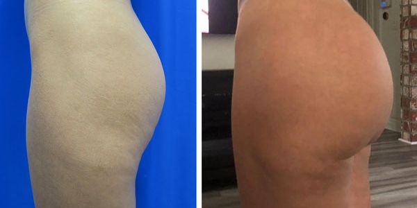before and after buttock implant left side view of female patient 740