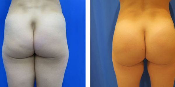 before and after buttock implant rear view of female patient 743