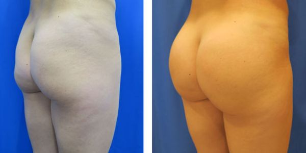 before and after buttock implant right angle view of female patient 743