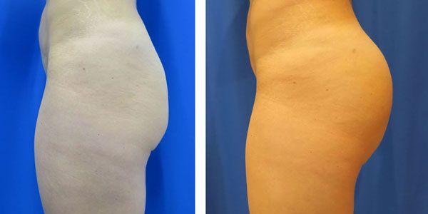 before and after buttock implant left side view of female patient 743