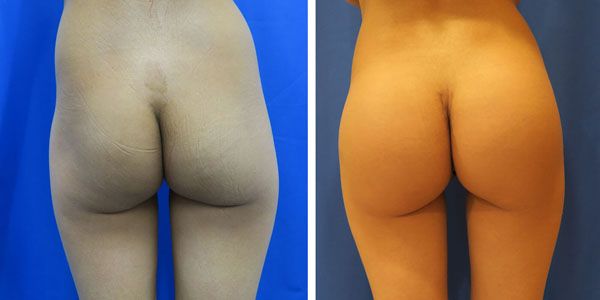 before and after buttock implant rear view of female patient 747
