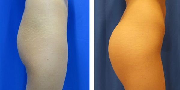 before and after buttock implant right side view of female patient 747