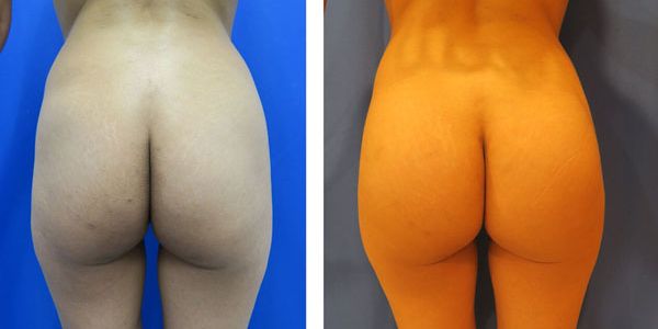 before and after buttock implant rear view of female patient 751