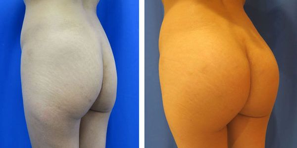before and after buttock implant left angle view of female patient 751