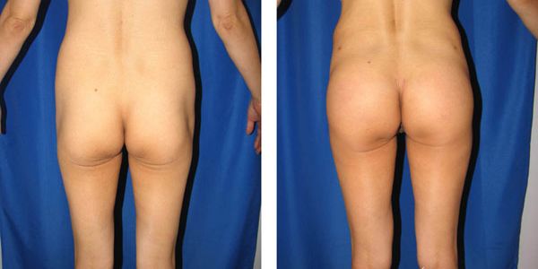 before and after buttock implant rear view of female patient 755