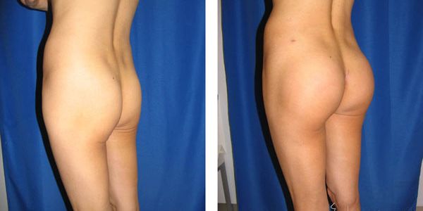 before and after buttock implant left angle and side of female patient 755
