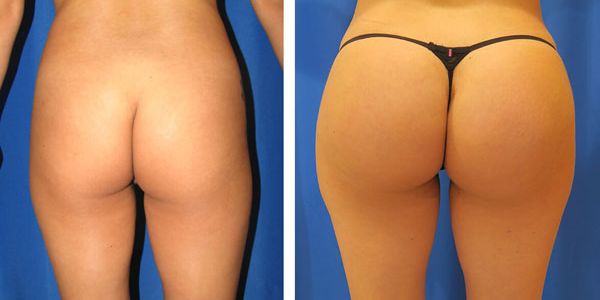before and after buttock implant rear view of female patient 763