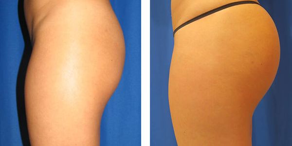 before and after buttock implant left side view of female patient 763
