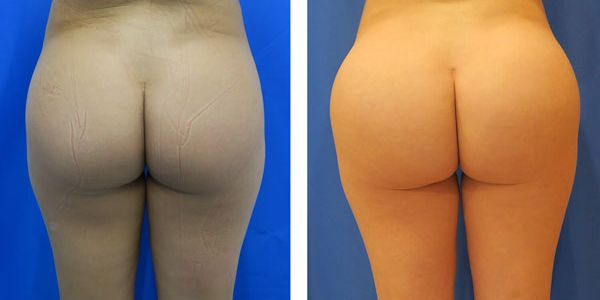 before and after buttock implant rear view of female patient 766